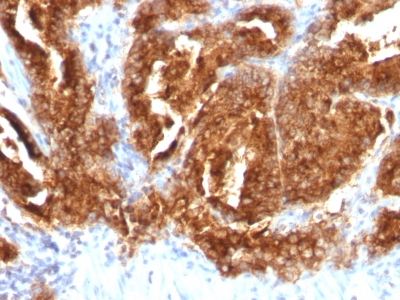 FFPE human prostate carcinoma sections stained with 100 ul anti-TAG-72 / CA72.4 (clone CA72/733) at 1:300. HIER epitope retrieval prior to staining was performed in 10mM Citrate, pH 6.0.